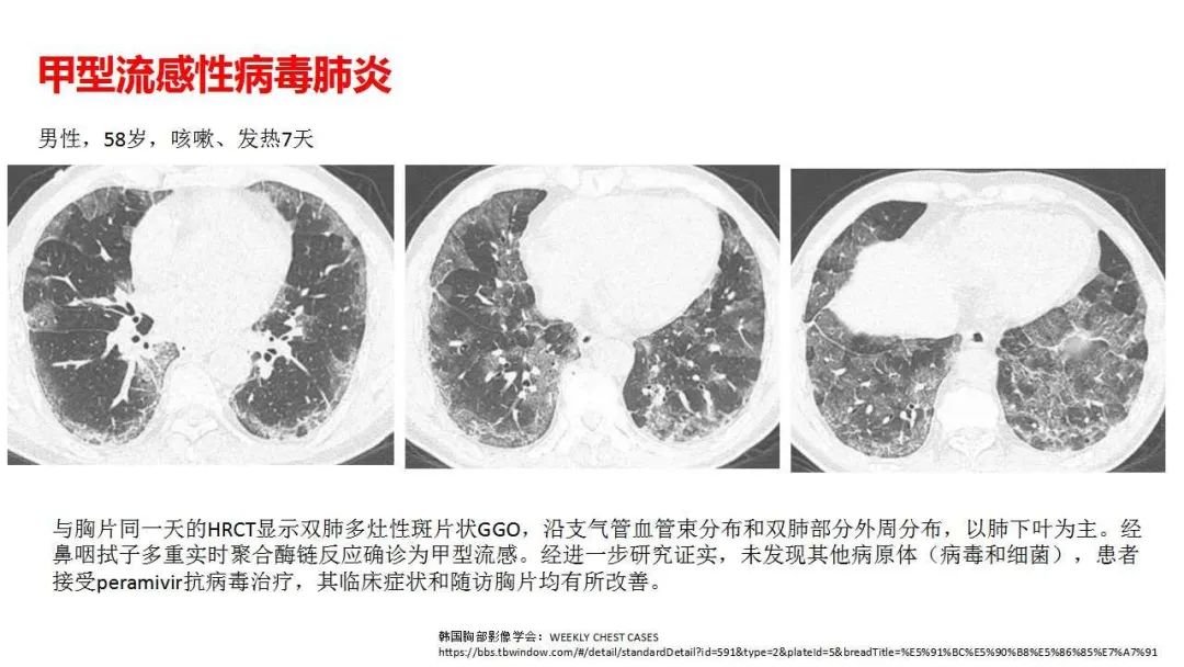 全球冠状病毒肺炎最新动态，疫情进展与应对策略概览