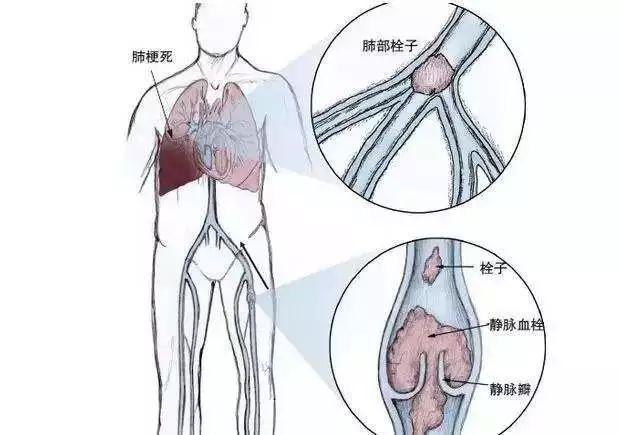 飞机旅行中的健康危机，预防肺栓塞指南的重要性与男子乘飞机身亡警示