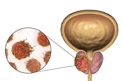 膀胱肿瘤最新治疗方法，小巷深处的医学奥秘探索