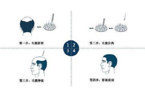 克隆毛囊植发最新动态与步骤指南