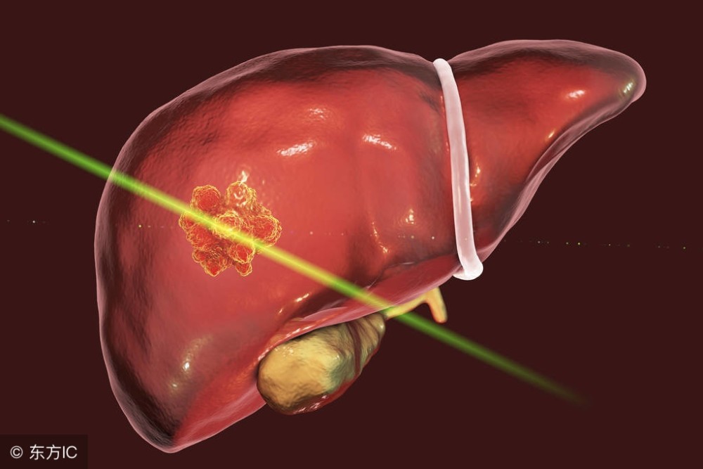 最新肝癌晚期治疗方法揭秘